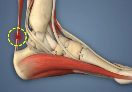 Хольгер Руне выбывает из строя: предстоит операция на ахилловом сухожилии